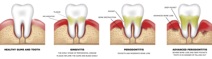 gum disease progression chart