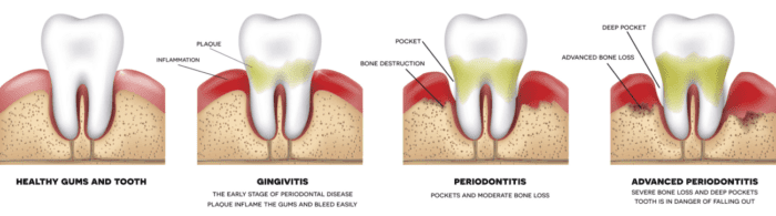 Periodontal Gum Chart