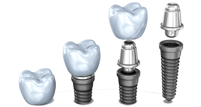 Affordable dental implants in Owings Mills Maryland