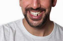 the result of tooth loss in Owings Mills Maryland