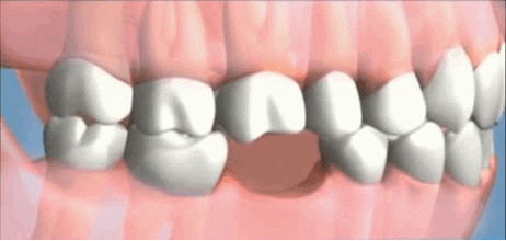 replace missing teeth in Owings Mills MD