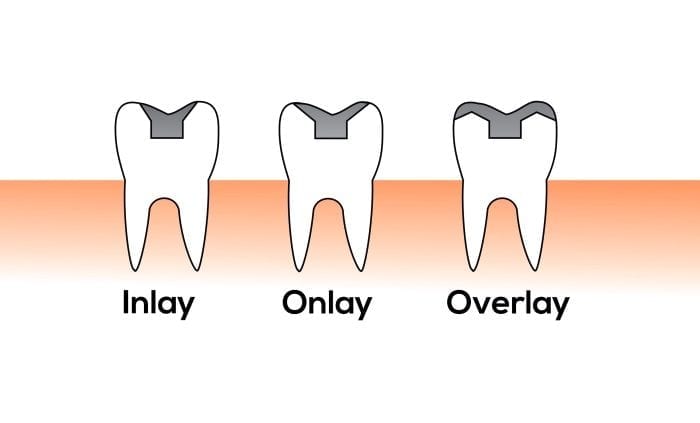 Dental inlays and onlays in Owings Mills MD