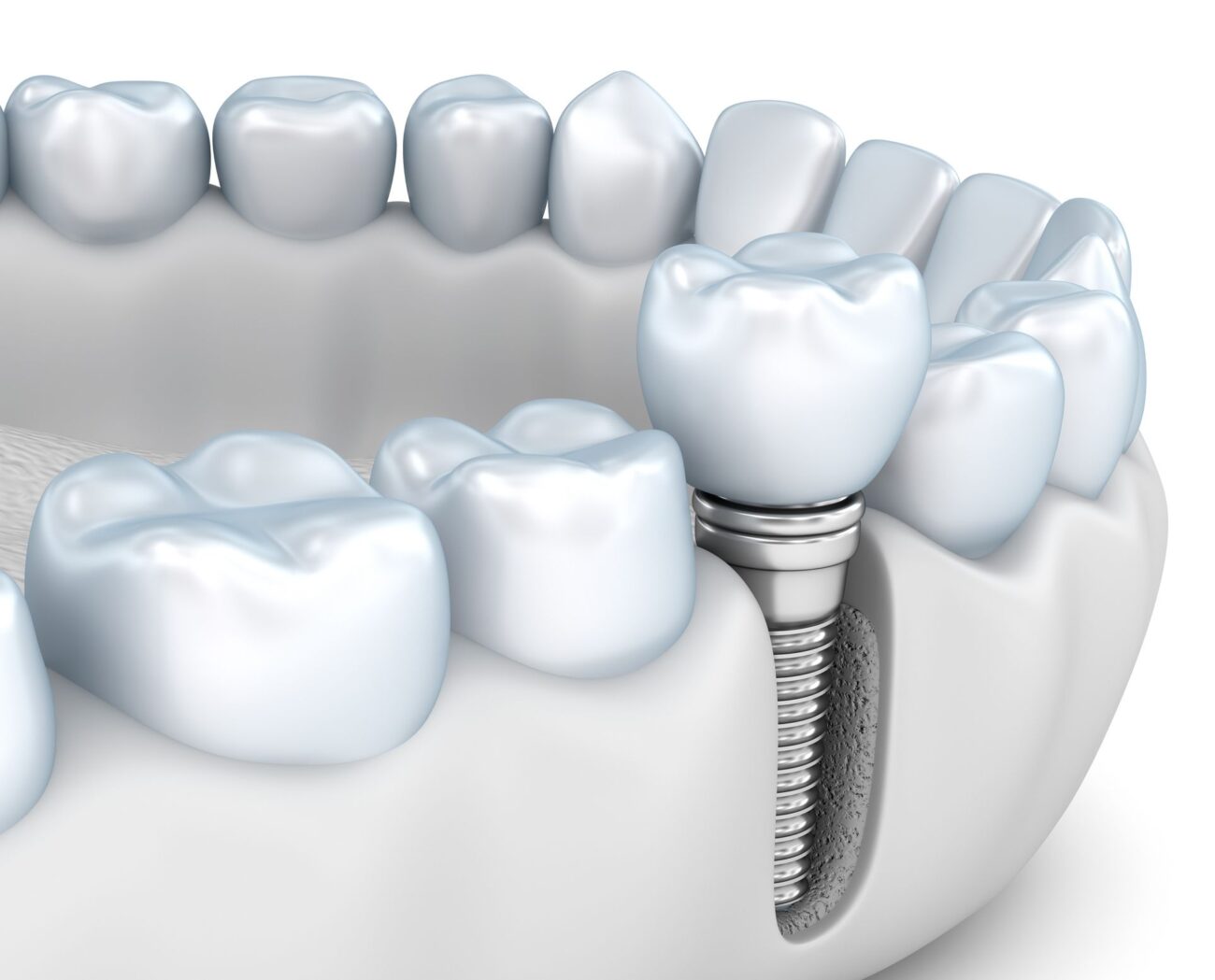 dental implants regenerate jawbone in Owings Mills Maryland