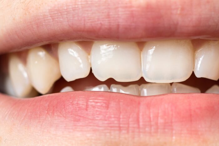 tooth damage in Owings Mills, MD