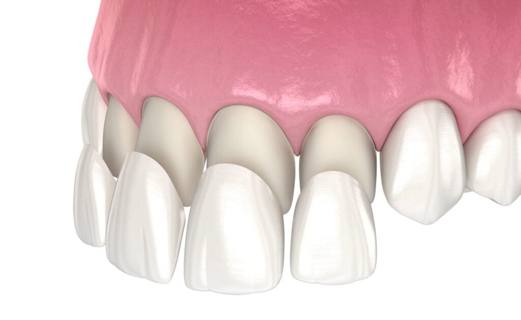 Affordable porcelain Veneers in Owings Mills, MD