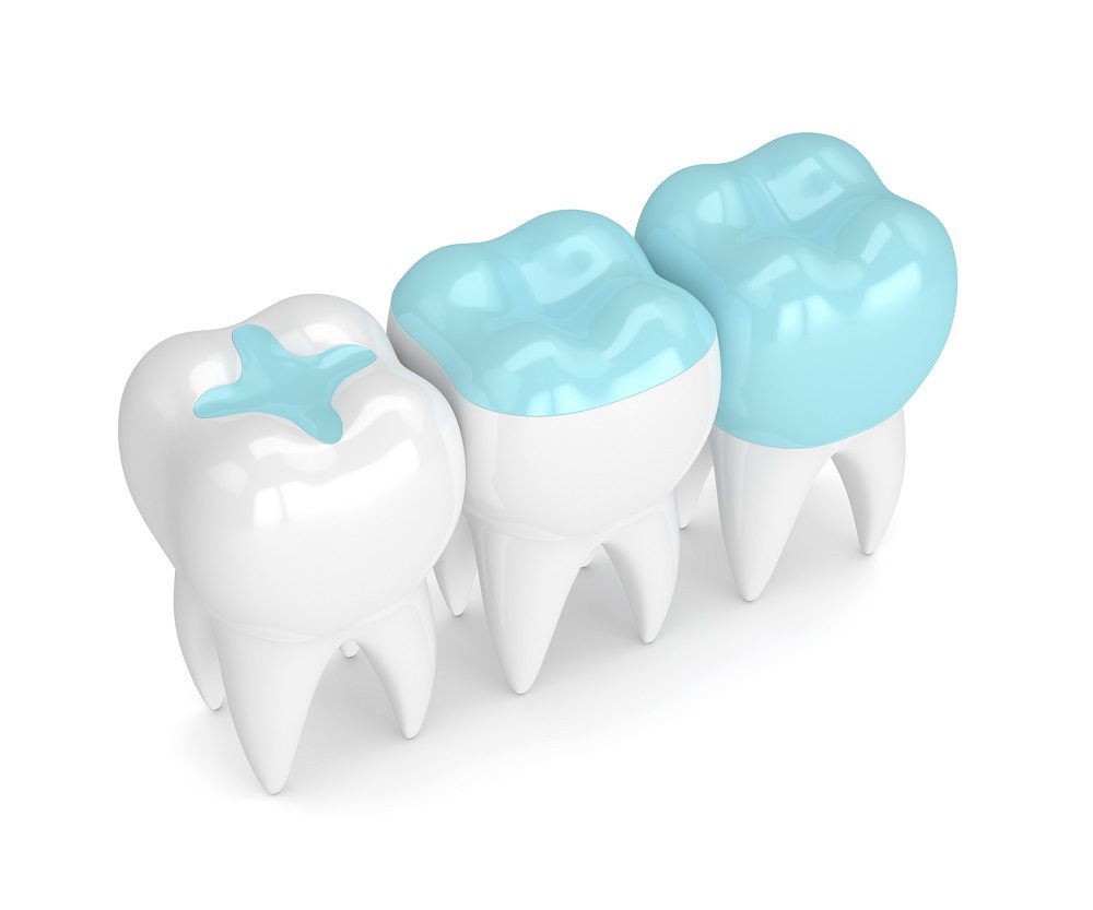 Inlays and Onlays in Owings Mills, MD can help fix a variety of dental problems