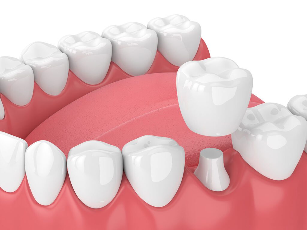 DENTAL CROWNS in OWINGS MILLS, MD, can be used to treat a variety of problems