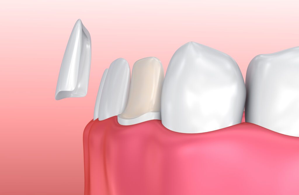 PORCELAIN VENEERS in OWINGS MILLS MD can help improve your smile and restore your bite.