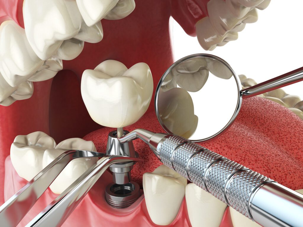 DENTAL IMPLANTS in OWINGS MILLS MD can take between three and six months to complete