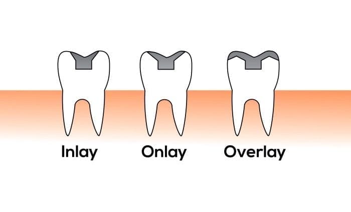 Dental inlays and onlays in Owings Mills MD