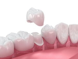 There are a few special considerations that help maintain both the dental crown and the surrounding gum tissue.
