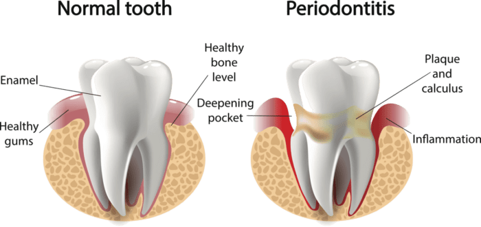 gum disease treatment in owings mills, maryland