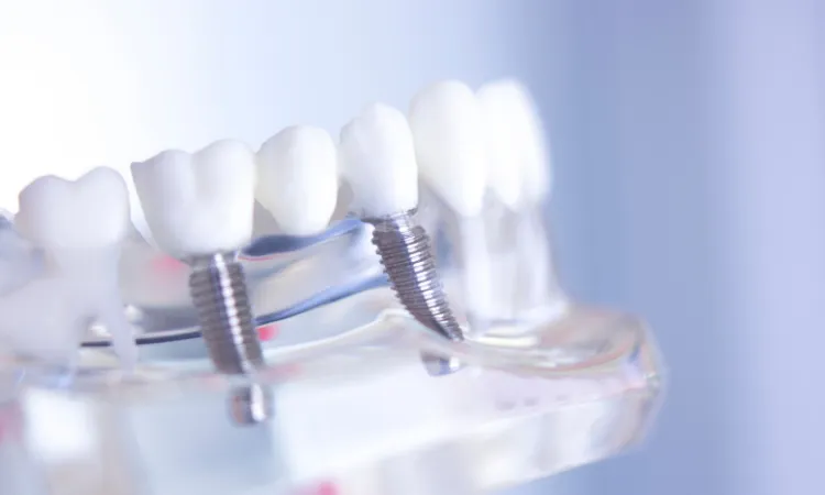 Dental Implants vs. Bridges: Which Is Right for You? in Owings Mills, MD